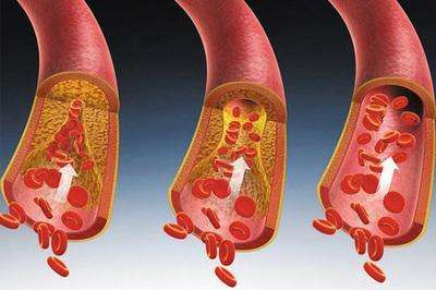 冠状动脉硬化能治好吗？控糖降压不能少！